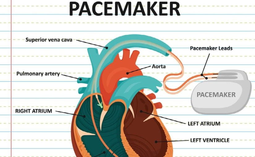LIVING WITH A PACEMAKER